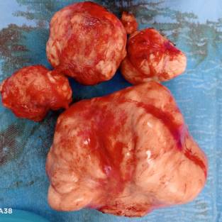Multiple uterus fibroids removed from 33 years woman by Dr. Nailah Nisar